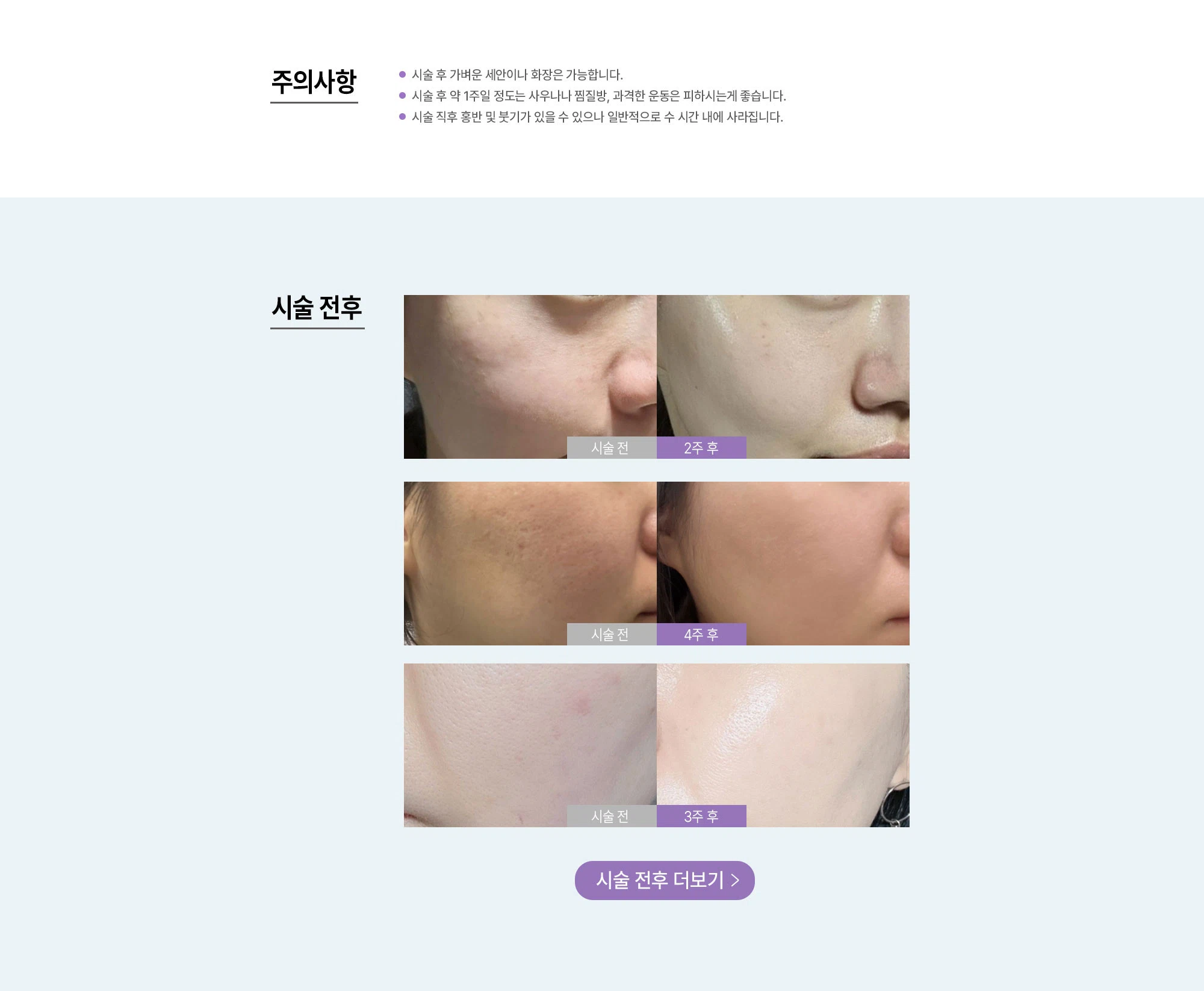 PDRN 연어주사