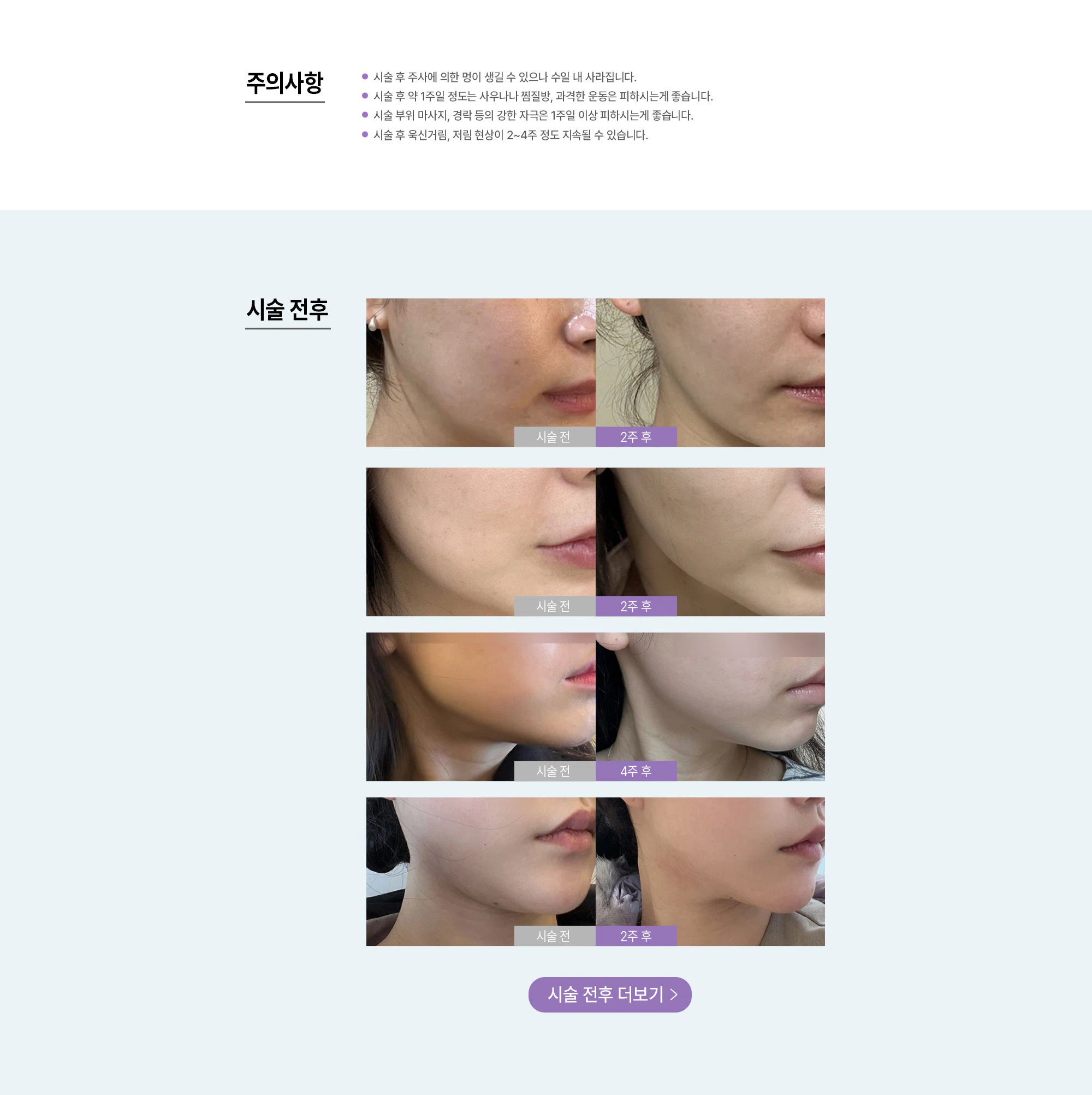 사각턱 보톡스