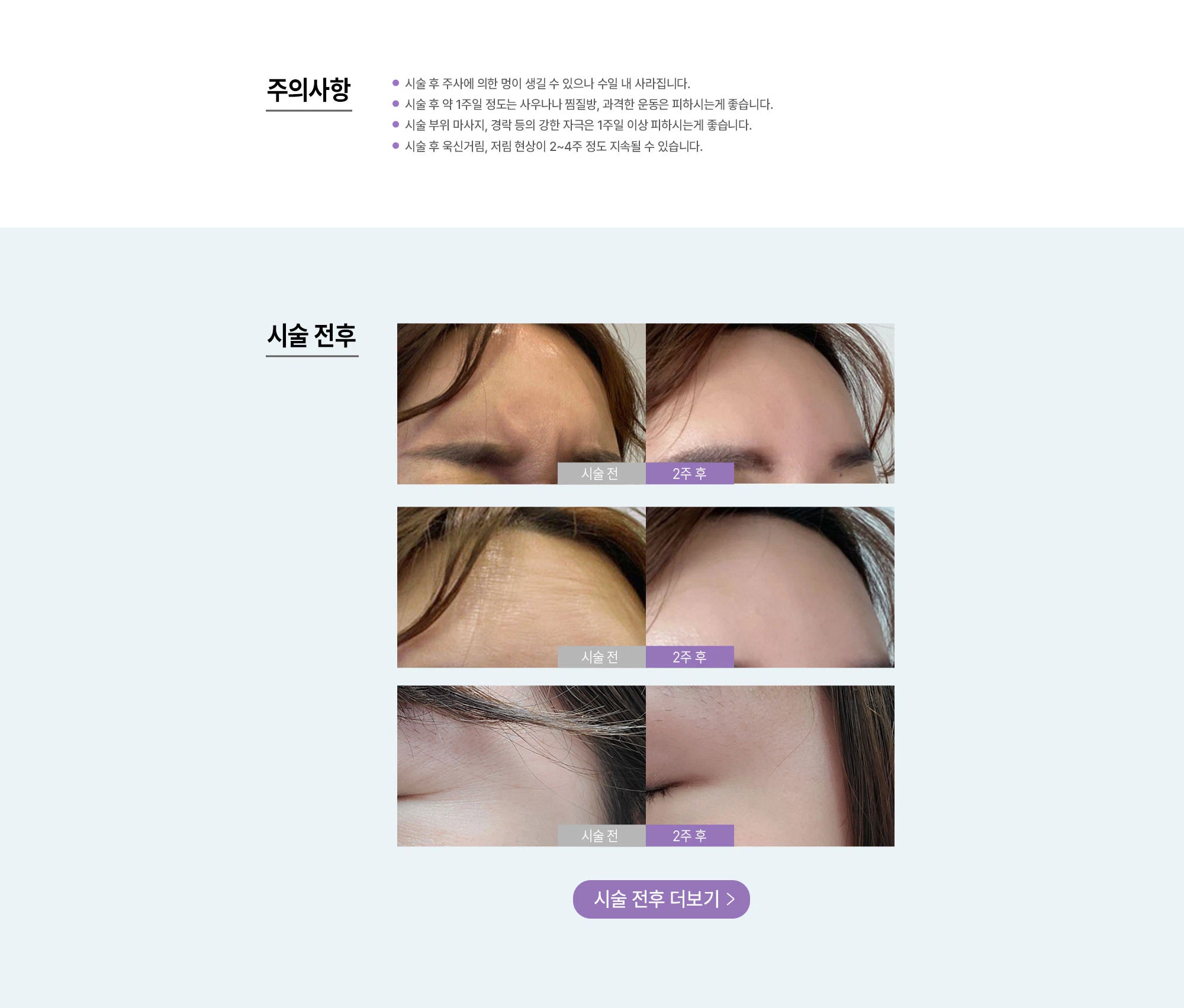 주름 보톡스