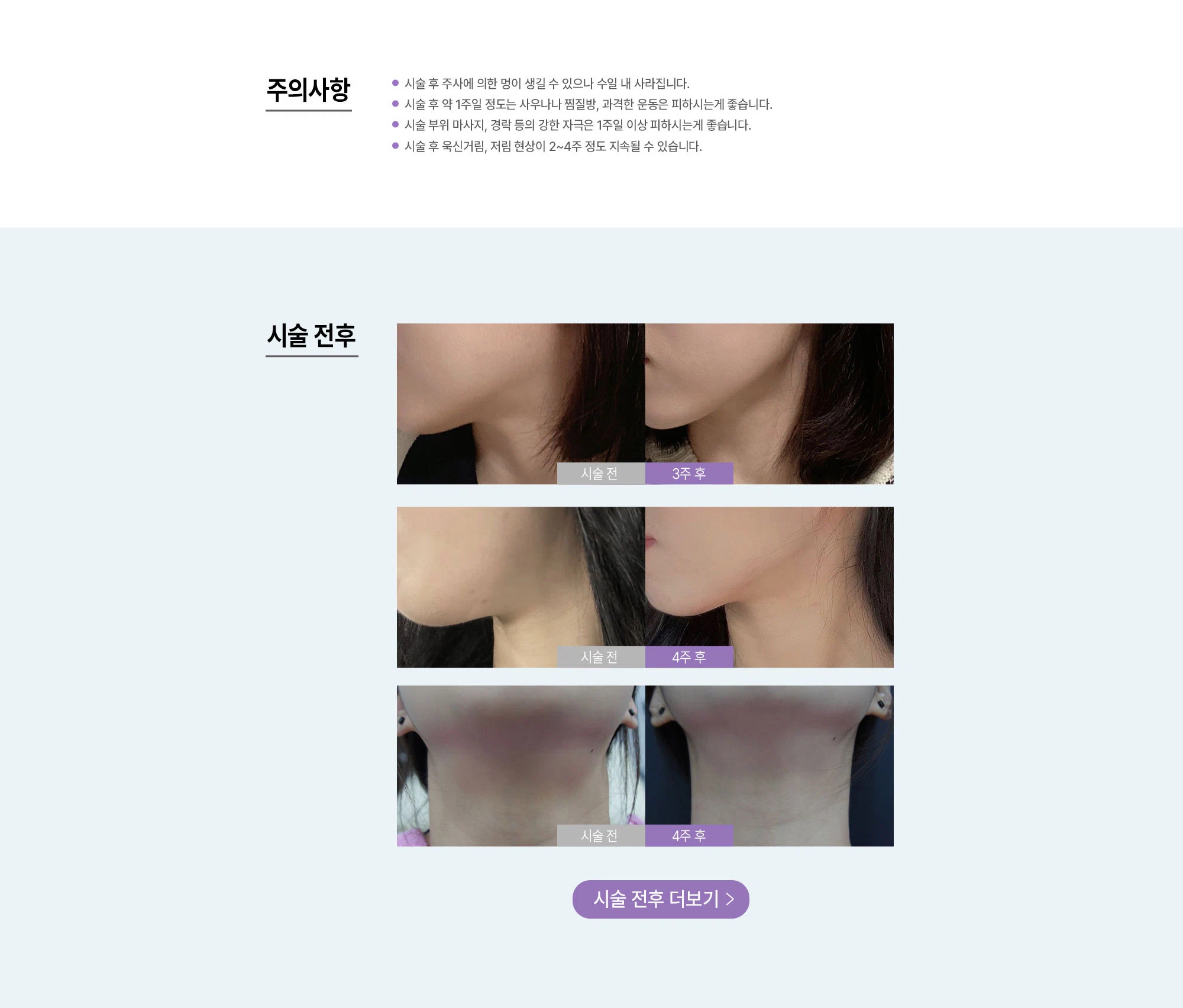 침샘보톡스