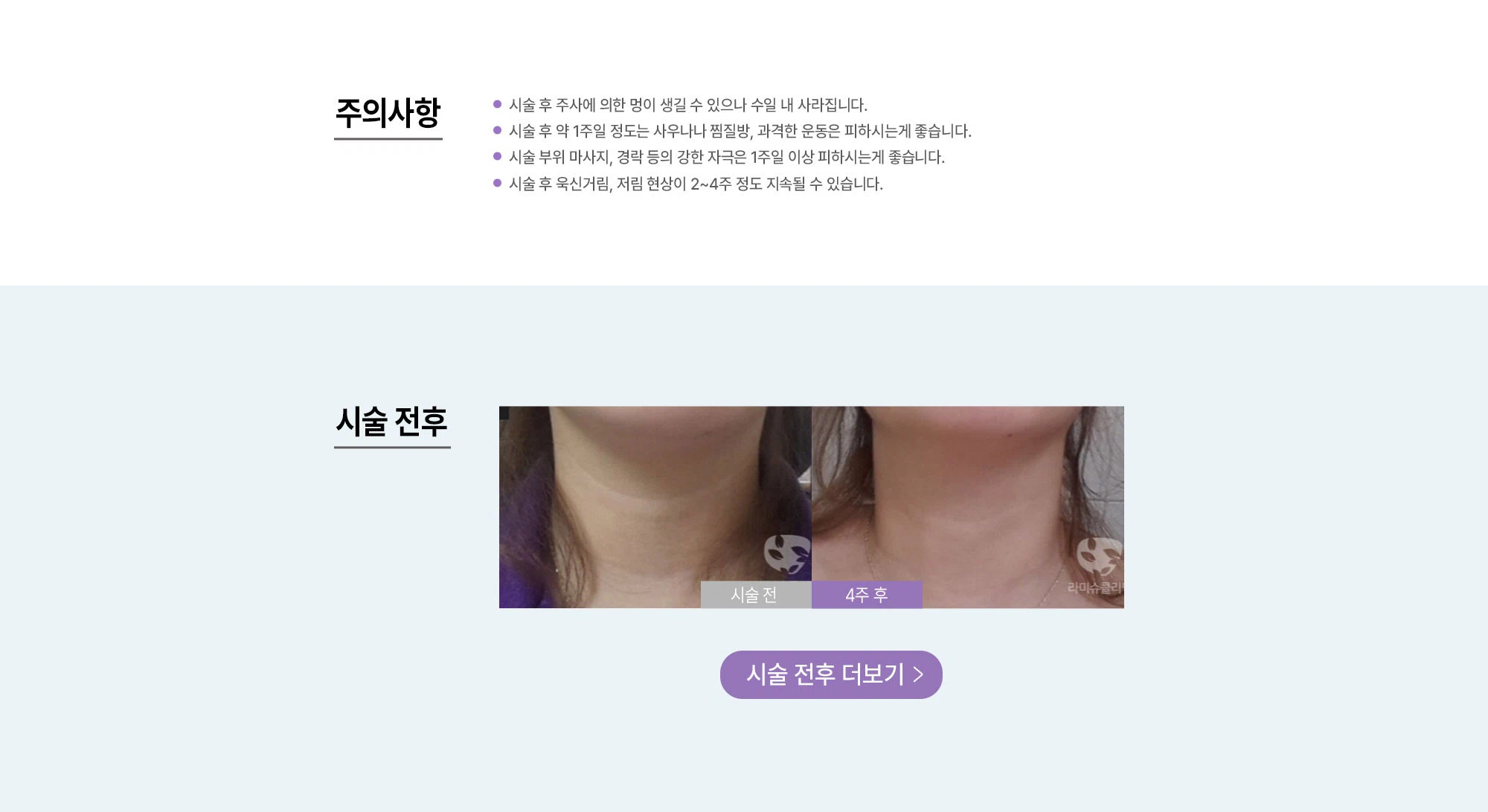 목주름 보톡스