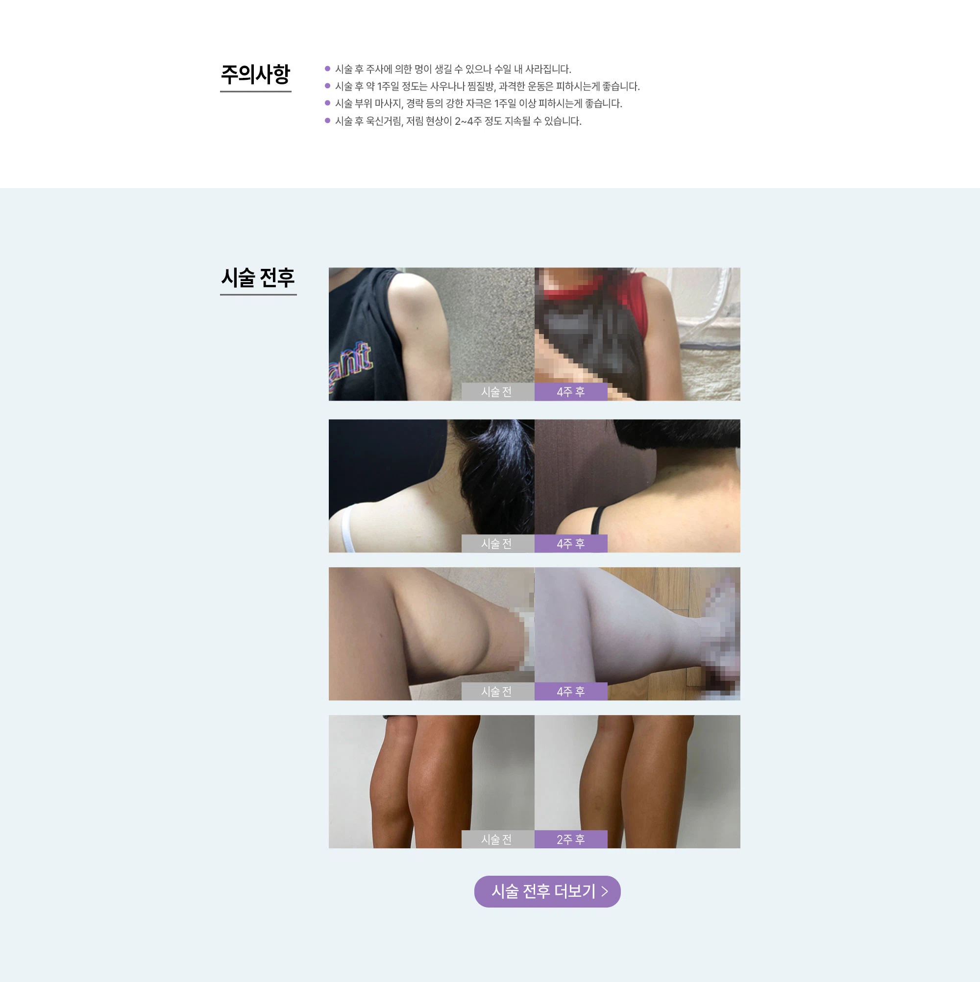 바디보톡스
