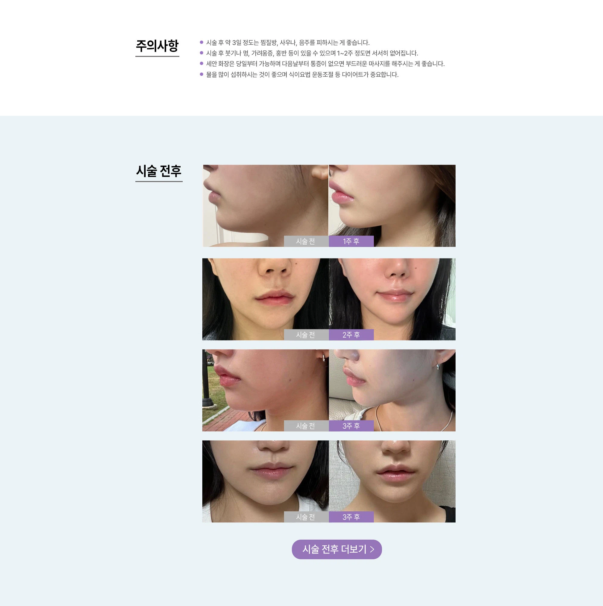 NS윤곽주사