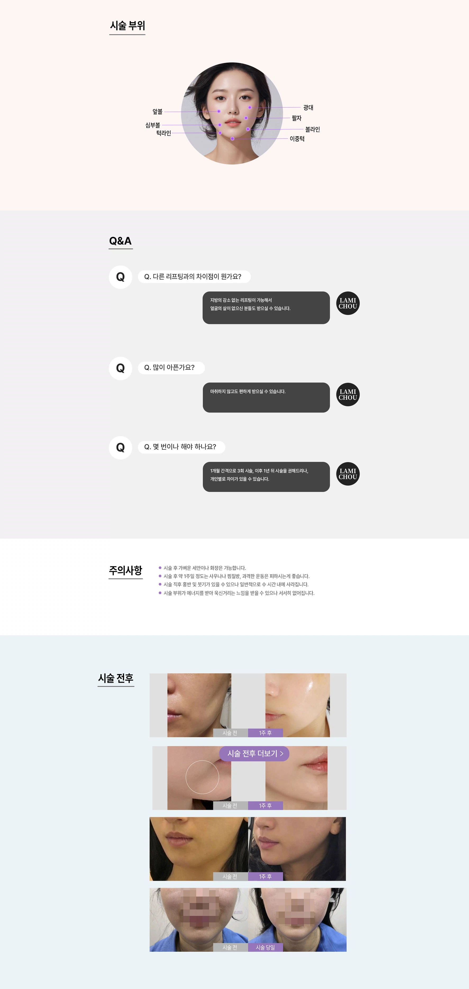 울타이트 리프팅