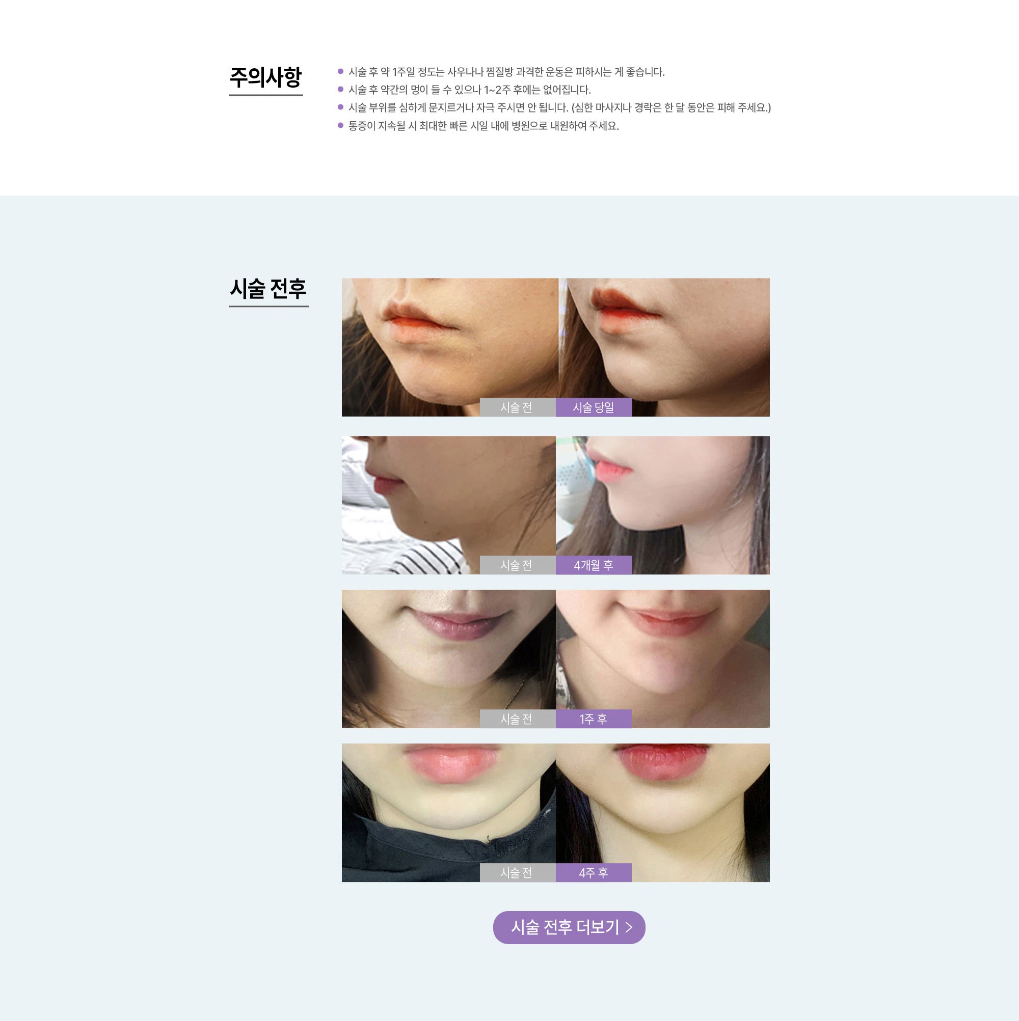턱끝/무턱 필러