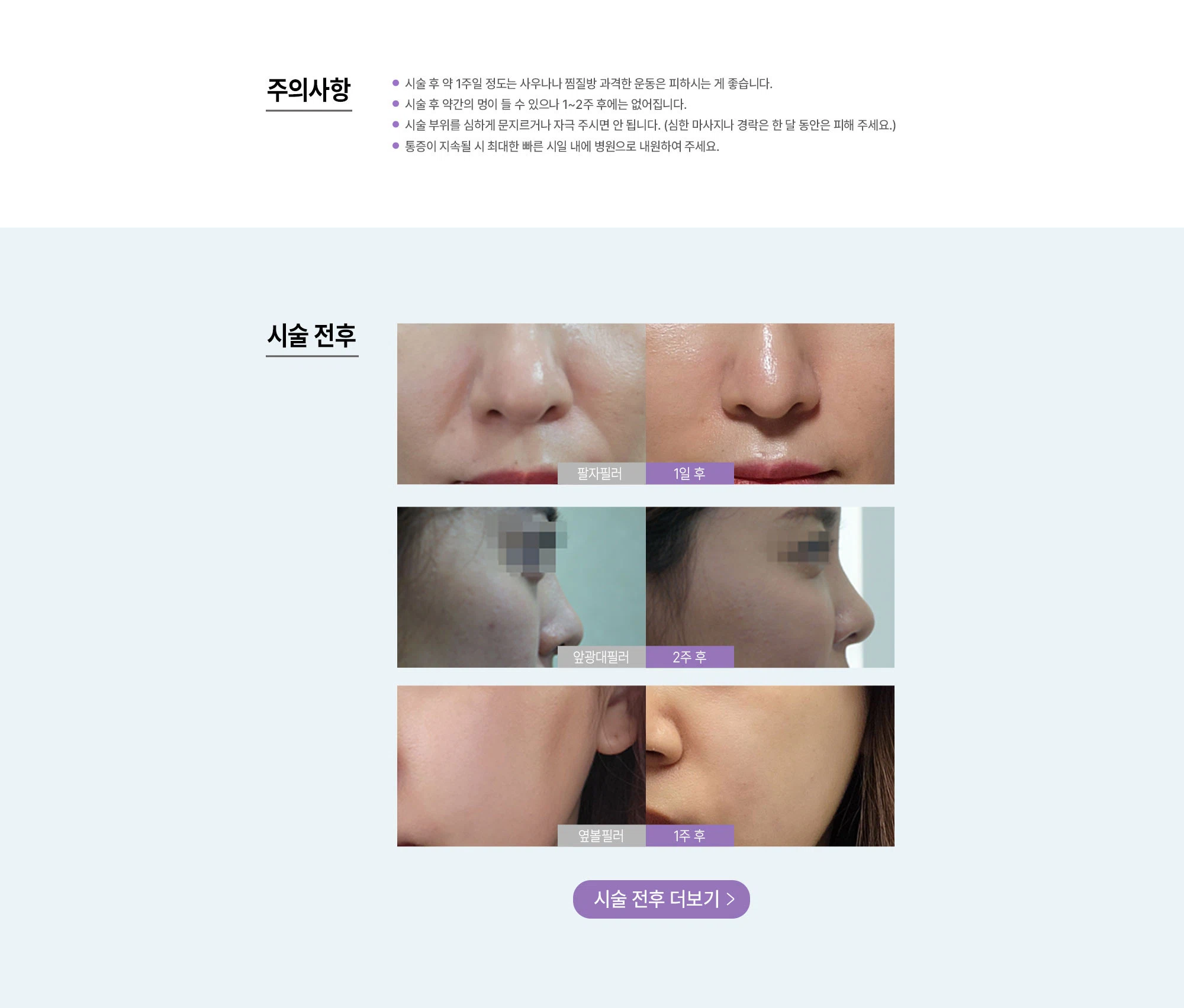 팔자/볼꺼짐/앞광대 필러