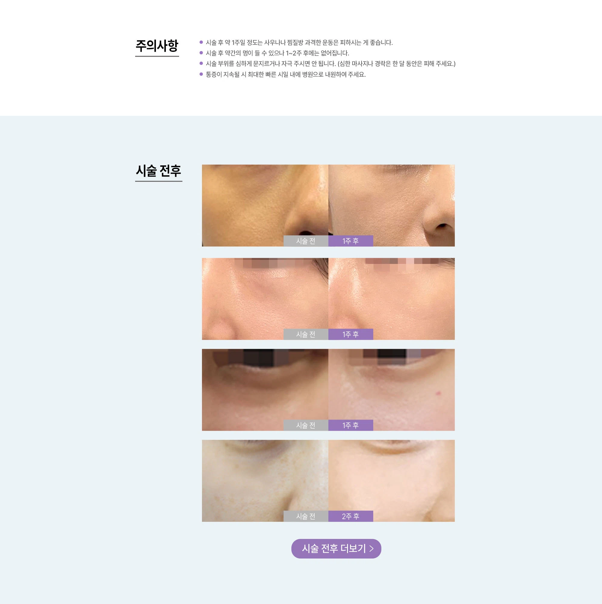 눈밑 필러